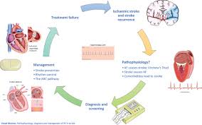 Image result for Stroke Pathophysiology