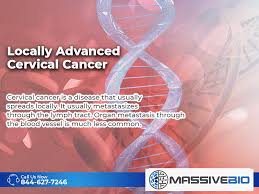 But hearing the words can still be scary. Locally Advanced Cervical Cancer Stage 1b2 To 4a Massive Bio