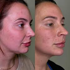 SO EXCITED to announce that we now have @glo2facial at MAC 💗 @sknbyerin  will be showing you all this at our ONE YEAR OPEN HOUSE Be sure to check  out the specials