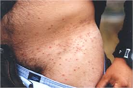 Your pets are bringing them in and lying on your bed. The Role Of Chiggers As Human Pathogens Intechopen