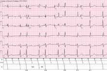 Heart Block Wikipedia