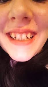 British mum says 'amazing' Fab Smile Veneers transformed her crooked teeth 