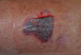 Image result for Skin Tear