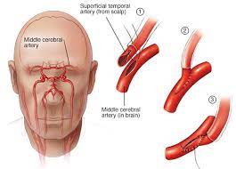 Moyamoya Disease Causes Symptoms Life Expectancy Treatment