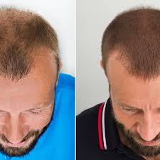 Helle haut, helles haar wie bei christian lindner. Pin Auf Pflege