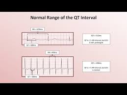 Image result for QT Interval