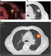 In this article they describe a variety of pulmonary conditions that can present with imaging features mimicking those of primary lung cancers. Follow Up Of Patients After Stereotactic Radiation For Lung Cancer A Primer For The Nonradiation Oncologist Journal Of Thoracic Oncology