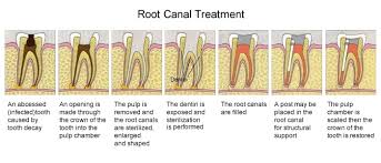 Does getting a crown hurt afterwards. Dental Tips Telltale Signs That You May Need A Root Canal In The Future