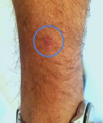 Learn About Extramammary Paget S Disease Empd Myempd Com