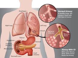 3 Ingredient Remedy That Clears Lung Mucus Immediately Clear Lungs Mucus Cystic Fibrosis