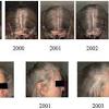Treating ringworm on the scalp requires prescription medication, so you'll need to see a doctor. Https Encrypted Tbn0 Gstatic Com Images Q Tbn And9gcqhqbd8lkaxdyakr69ldunnczob69p6utxmv5tukik9uc Hc2ww Usqp Cau