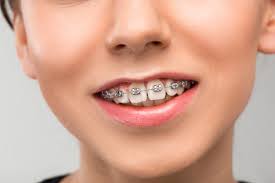 If your overbite is major, it could take you over two years to finally get a new smile. Overbite Braces Their Cost And How They Work Orthodontic Experts