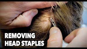 This video will demonstrate the steps on how to properly remove surgical staples on a patient who ha. Removing Head Staples Ouch Dr Paul Youtube