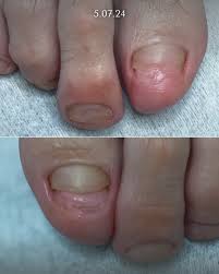 Image result for mykoza nehtů