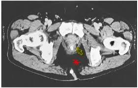The hip bones (ossa cosarum) meet at the pelvic symphysis ventrally, and articulate with the sacrum dorsally. Block 7 Anatomy Brs Pretest Pelvis Pt2 Proprofs Quiz