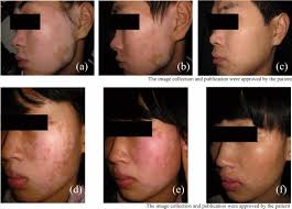 CXCL9 as a key biomarker of vitiligo activity and prediction of the success  of cultured melanocyte transplantation