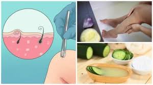 The worst part is it starts taking root and growing, leaving a sort of ring on the skin. 5 Natural Remedies That May Help You Get Rid Of Ingrown Hairs Step To Health