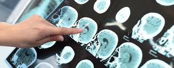 Hirntumor Symptome Und Lebenserwartung Focus Arztsuche