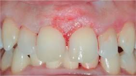Image result for granuloma gum disease