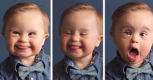 Afbeeldingsresultaat voor uiterlijke kenmerken downsyndroom