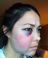 Her second and last trip. Samantha Quek On Twitter 7 Years Ago Today Wallop Right In The Boat Race With A Hockey Ball I Remember That The Medical Staff Wouldn T Let Me Look At My Reflection