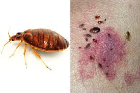 Insect Bites Guide Pictures And Treatment Advice For Bites