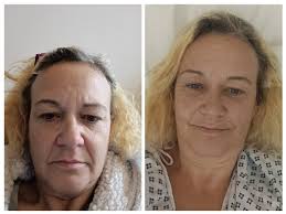 Has anyone had issues with their vitamin d levels? I have a friend who  keeps breaking bones and her vitamin d levels are extremely low even though  she takes a multi.