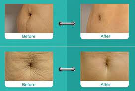 Three boxes of a course of treatment. The Treatment Of Stretch Marks Striae Distensae By Joel Bain Herron Md Northeast Dermatology Skin Dermatology