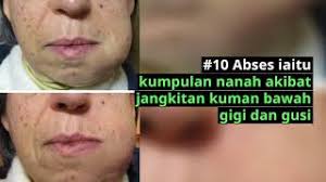 Disusul dengan artikel tentang manfaat konsumsi kacang kenari. Bengkak Di Leher Neck Swelling Penyebab Tanda Dan Rawatan