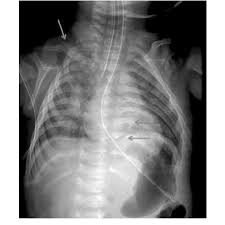 Be sure to subscribe to the visible body blog for more anatomy awesomeness! An Oblique View Of The Ribs On Skeletal Survey Shows Posterior Rib Download Scientific Diagram