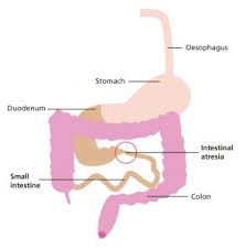 Image result for Intestinal Atresia