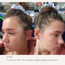 Hi Renee, last time we communicated was late April where I sent you some  photos of my daughter. I am now sending you her latest photo.....the  difference is amazing and it is