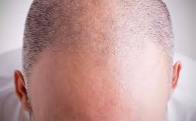 Alopecia areata (aa), a nonscarring type of hair loss, is the most prevalent autoimmune disease, with a lifetime prevalence of 1.7%. Can Steroids Cause Hair Loss The Bald Gent