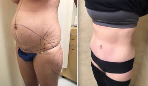 Body Contouring Along With Hernia Repair Dr Stuart A Linder