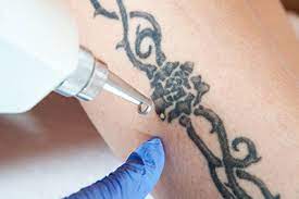 Three tattoo removal sessions for an area up to 4, 8, or 16 at dfw tattoo removal (up to 84% off). Laser Tattoo Removal Dallas Tattoo Lightening Plano Tx