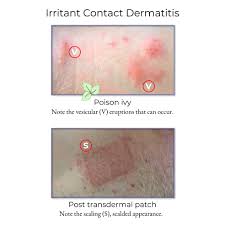 Image result for contact dermatitis