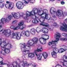 We did not find results for: Papillary Adenocarcinoma With Optically Clear Nuclei Orphan Annie Download Scientific Diagram