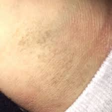 Was Sind Das Fur Braune Flecken Auf Der Haut Und Wie Behandelt Man Sie Gesundheit Und Medizin