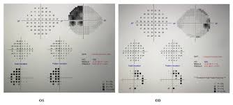 Image result for Visual Field Deficit