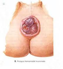 ¿qué causa la trombosis hemorroidal? Caracteristicas De Los Diferentes Tipos De Hemorroides