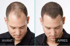 We did not find results for: Faux Cheveux Pour Homme Off 78 Cheap Price