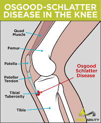 Osgood Schlatter Disease Treatment Exercises Surgery