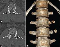 Maybe you would like to learn more about one of these? Pitfalls In The Radiographic Diagnosis Of The Transverse Processes Fracture Of The Lumbar Vertebrae Hegde Kv Umamaheswara Rv Agrawal A J Orthop Allied Sci