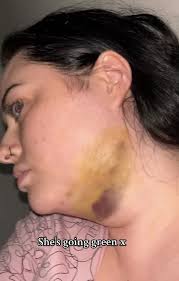 I had chin lipo TWICE to get rid of my double chin