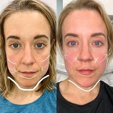 Robin Maher, RN & Advanced Injector (@kindred.yyc) • Instagram photos and  videos