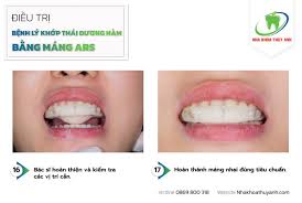 17 bước làm máng nhai điều trị viêm khớp thái dương hàm