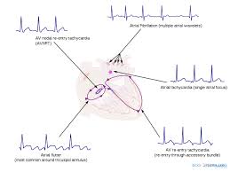 Delí sa na nepravidelnú svt (jednoduchá ekg diagnostika) a pravidelnú svt (zložitá ekg diagnostika). Supraventricular Tachycardia Wikiwand