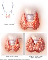Thyroid Nodules Symptoms And Causes Mayo Clinic