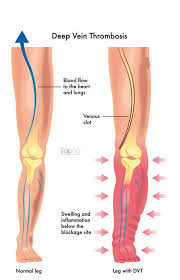 Pin On Peripheral Artery Disease