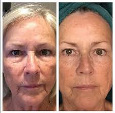 Before And After Using Re9 Advanced Skin Care System For 30 Days This Is My Friends Mom Doesnt She Look Amazin Advanced Skin Care Skin Care System Skin Care